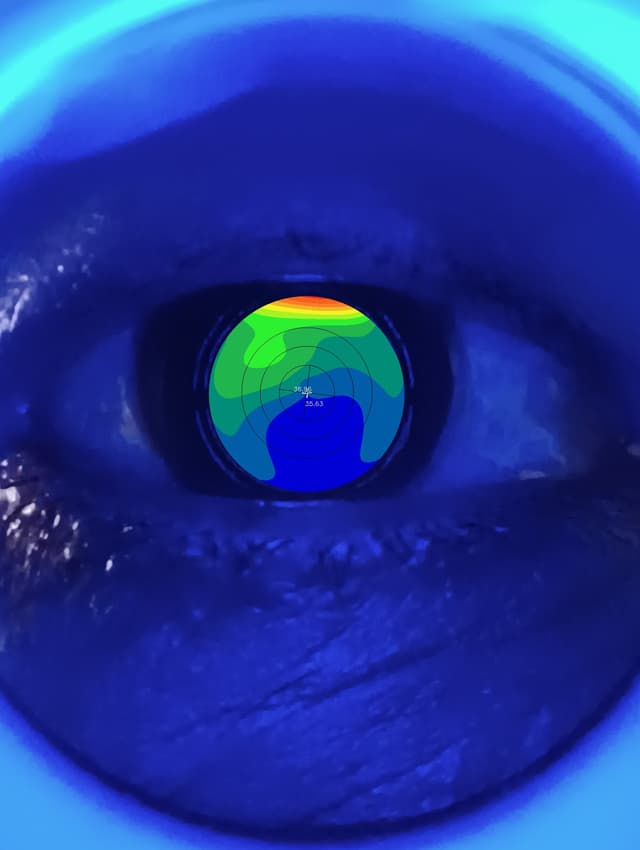 OcelluxKC: Portable Corneal Topographer image